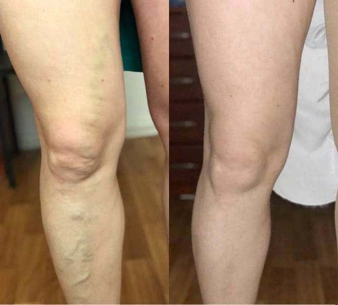 decât venele teribile du de la varicoza