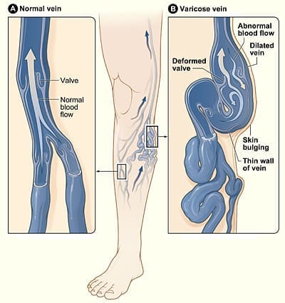 Schema de tratament cu varicoză la picior - Diagrama de tratament cu varicoza pentru medici
